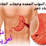 علاج التهاب المعده وحجاب الحاجز للاستاذ ثامر.ثامريات